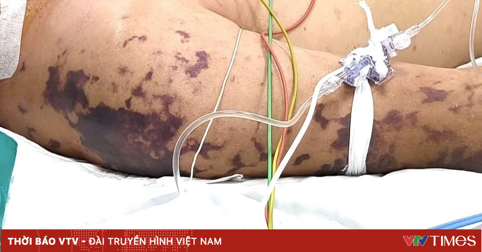 Nguy cơ lây bệnh não mô cầu tại môi trường tập thể