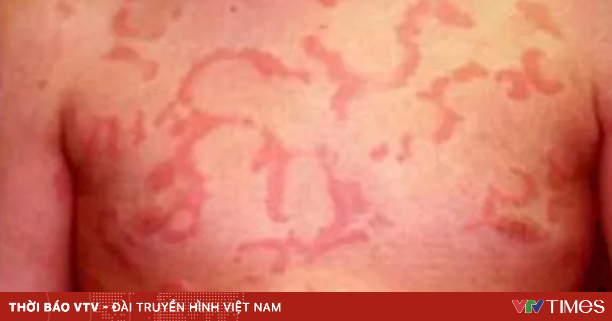 Lạm Dụng Corticoid Trong Điều Trị Mày Đay Có Thể Gây Hậu Quả Nguy Hiểm