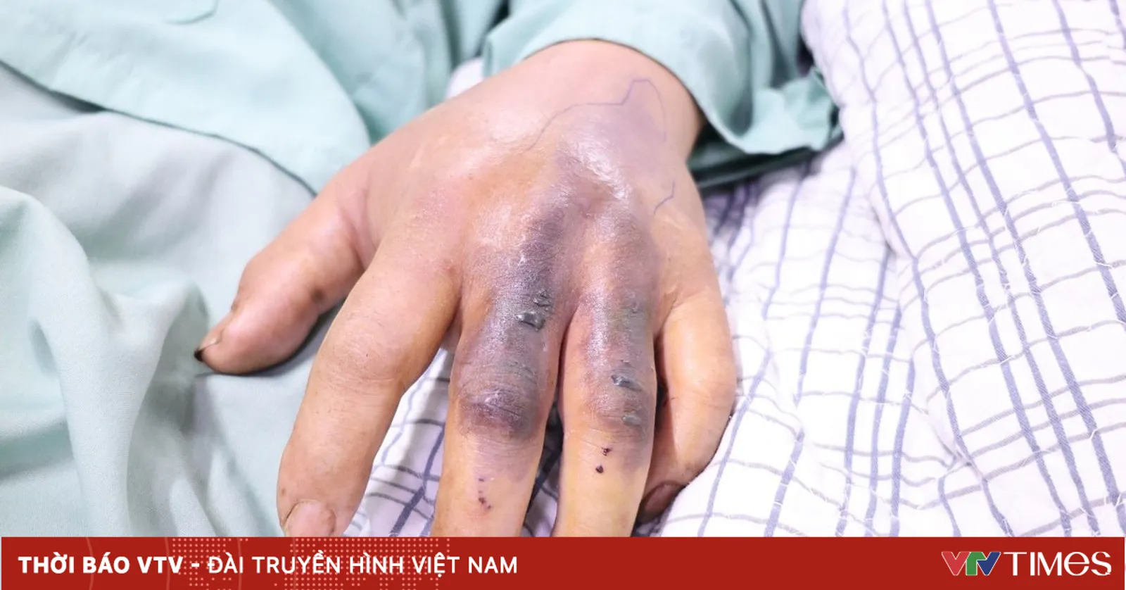 Cảnh báo nguy cơ rắn độc cắn mùa hè