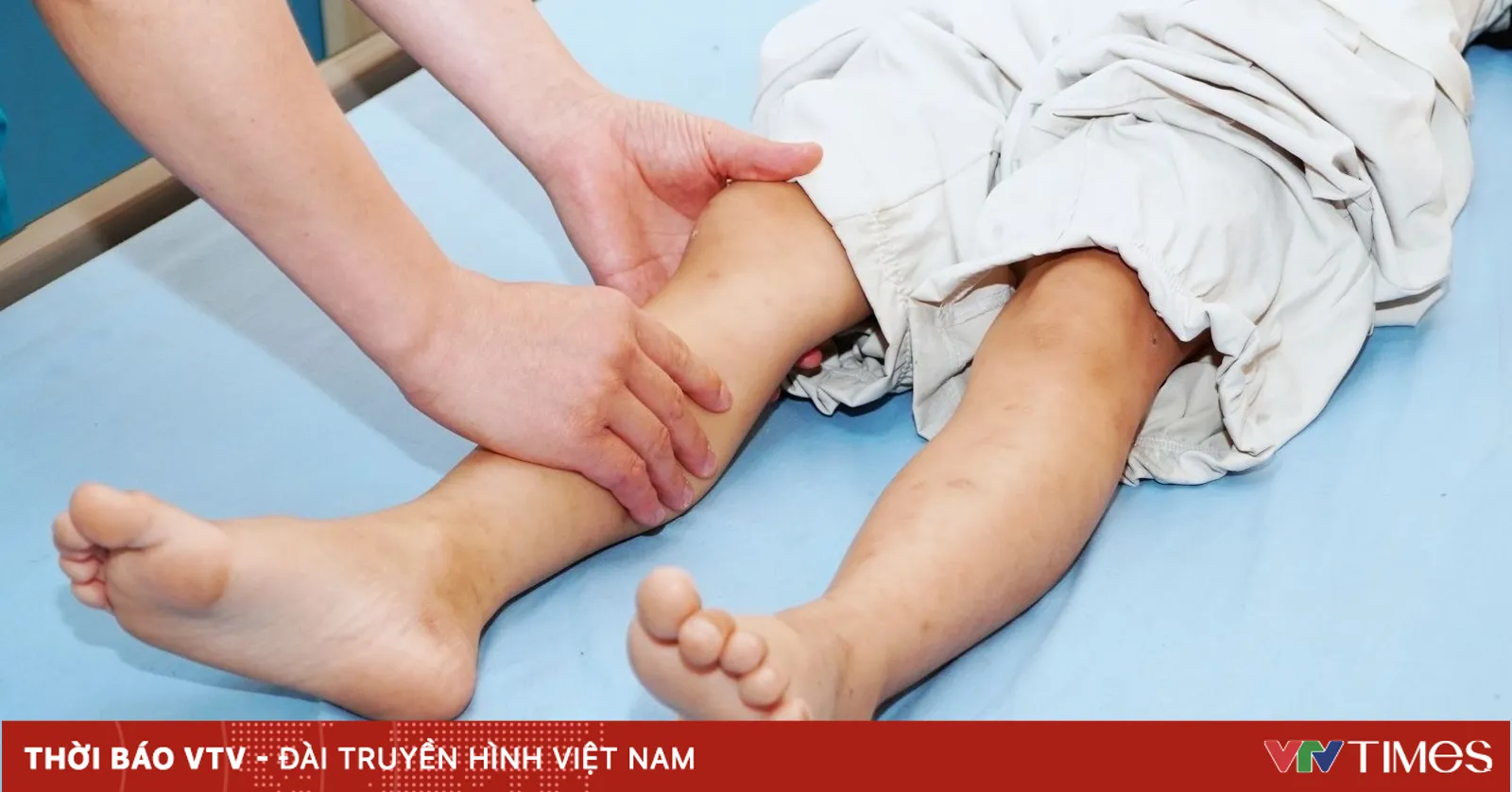 Cảnh báo nguy cơ tiêu cơ vân ở trẻ sau vận động gắng sức