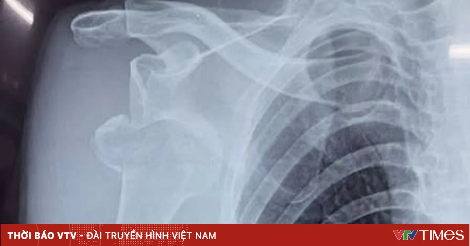 Cảnh giác biến chứng khi tự ý đắp lá, bó thuốc nam chữa gãy xương
