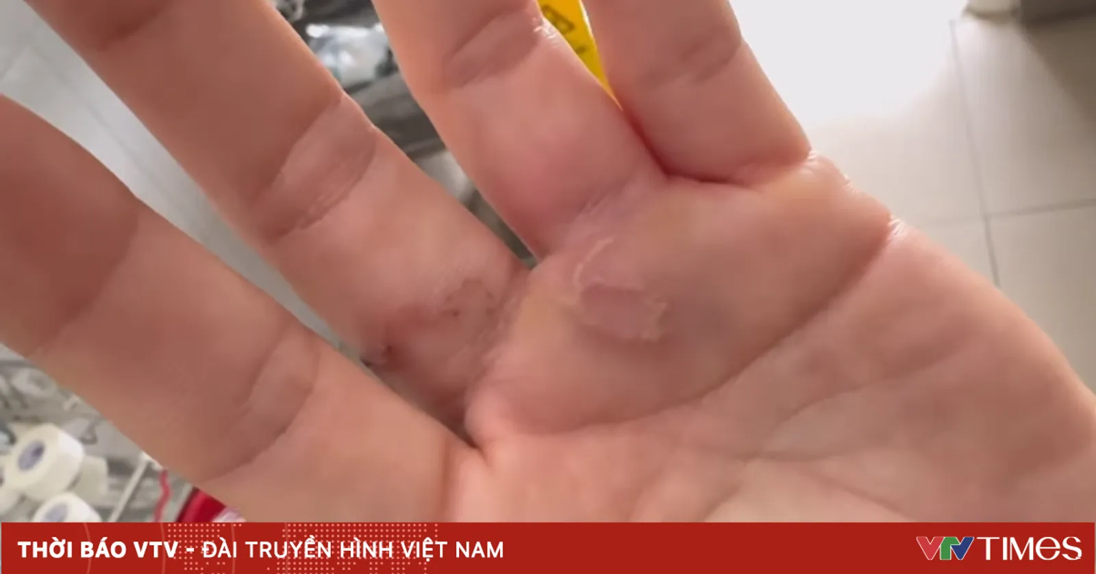 Mùa mưa, cảnh giác nguy cơ nhiễm ký sinh trùng, giun sán
