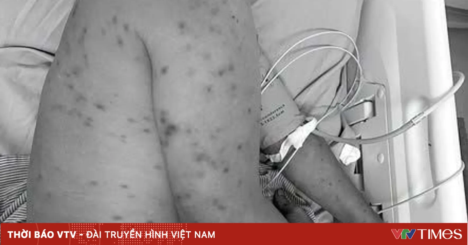 Nguy kịch khi bị hơn 300 con ong đốt