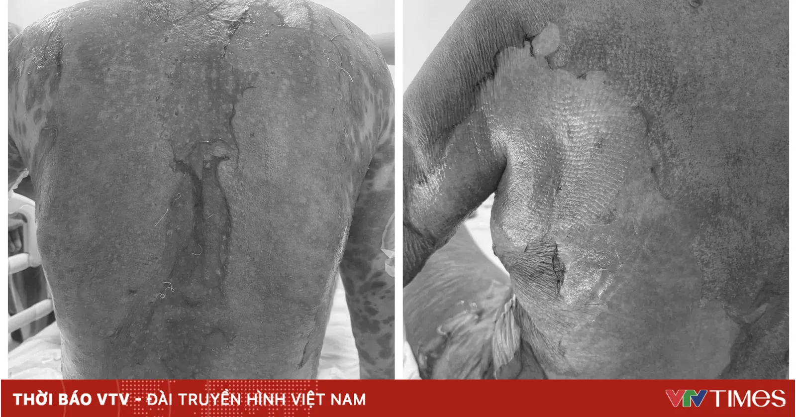 Cảnh giác hội chứng Lyell: Phản ứng da nguy hiểm do thuốc