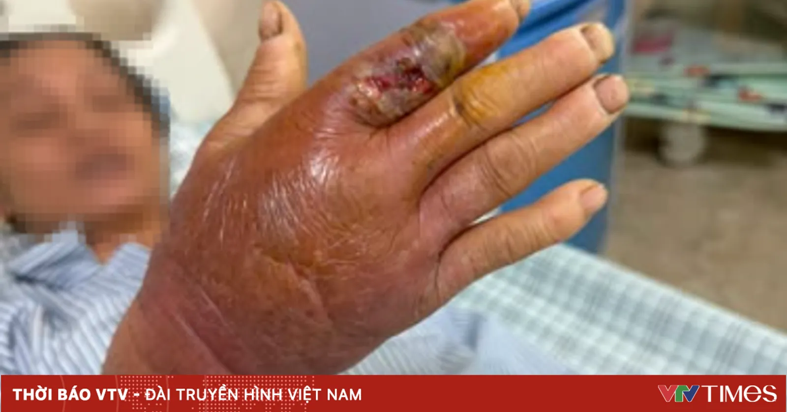 Cần nhập viện sớm khi bị rắn hổ mang cắn