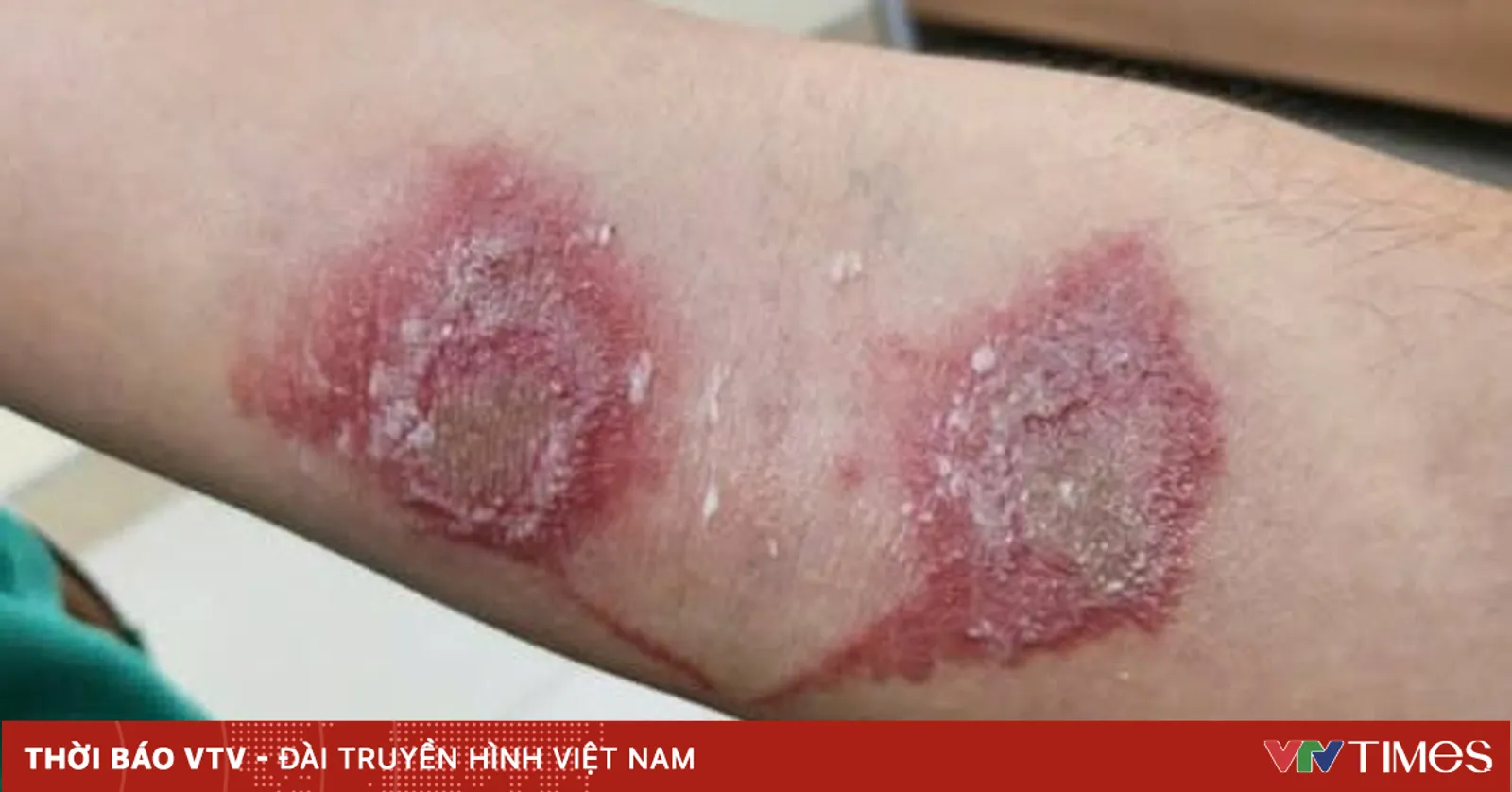Cẩn trọng: Viêm da do kiến ba khoang mùa mưa