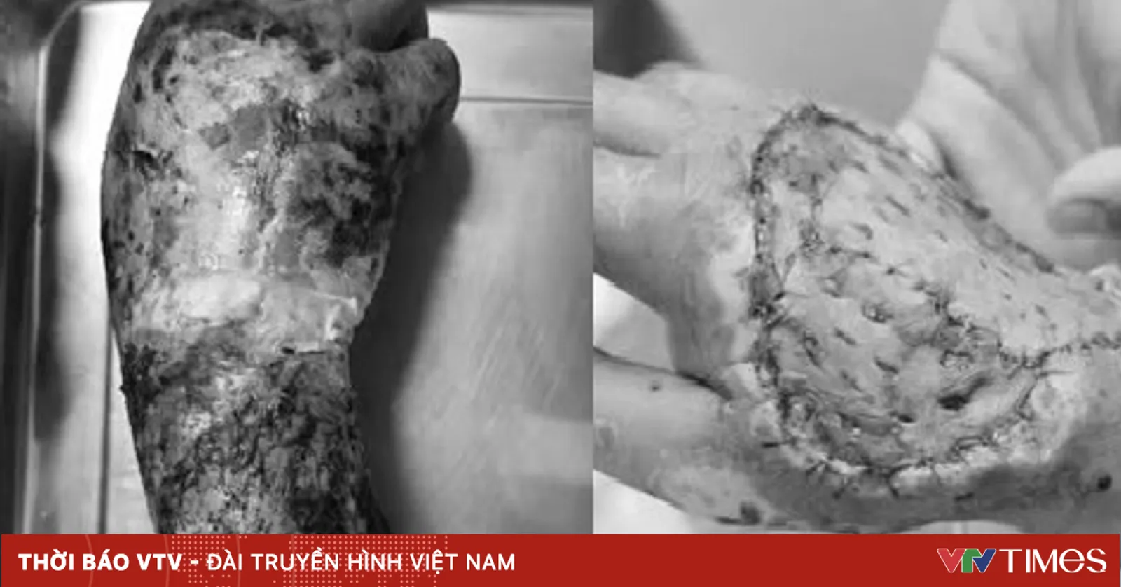 Hoại tử bàn tay sau khi đắp thuốc nam chữa rắn cắn
