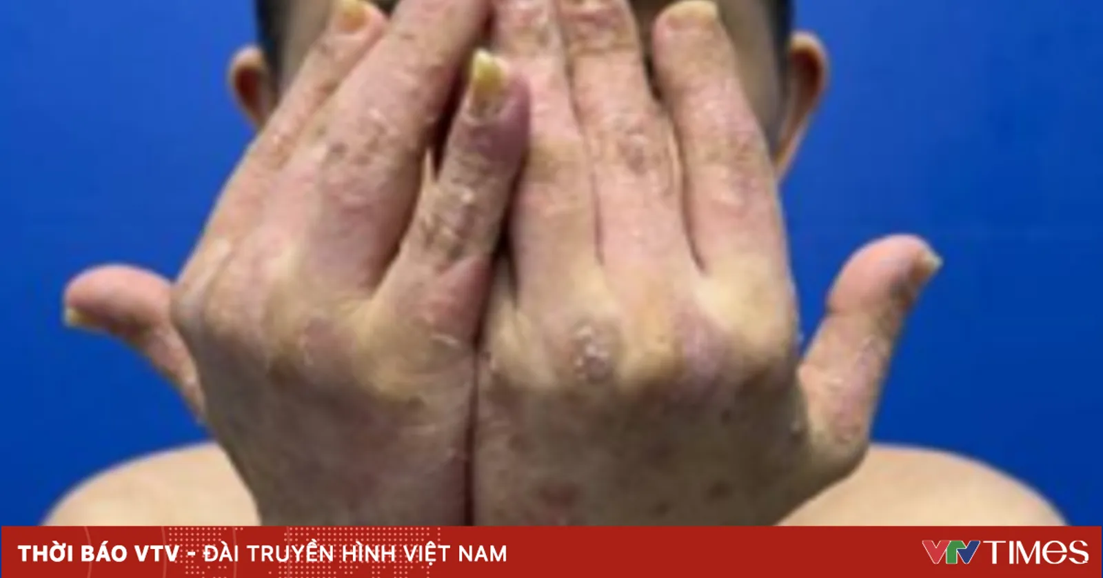 Hội chứng Down và vảy nến: Mối liên hệ cần lưu ý