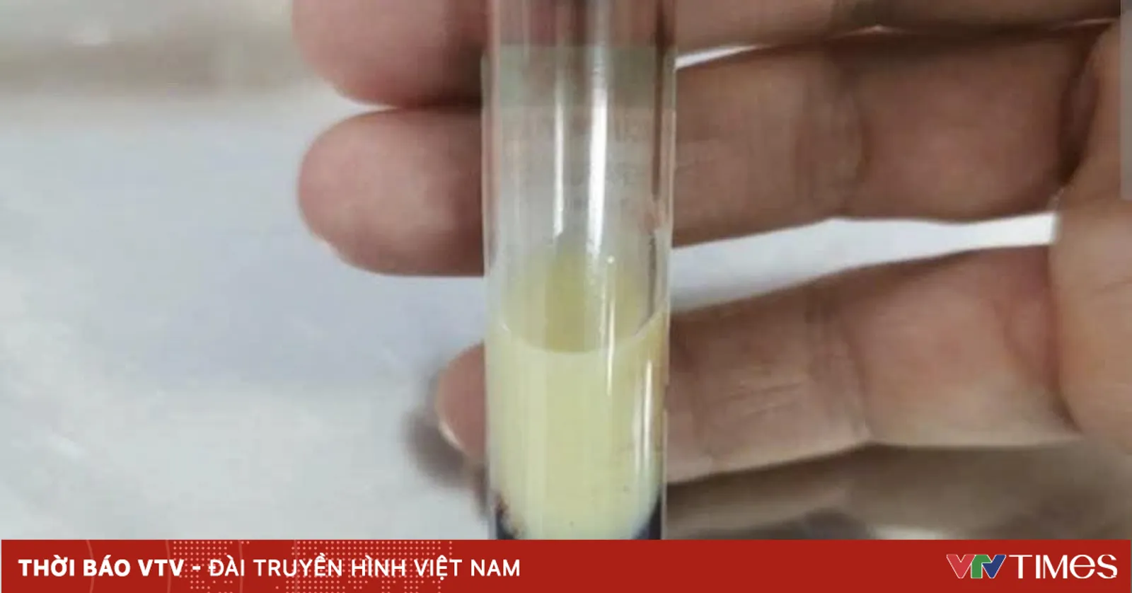 Cảnh báo nguy cơ biến chứng từ tình trạng tăng mỡ máu nặng
