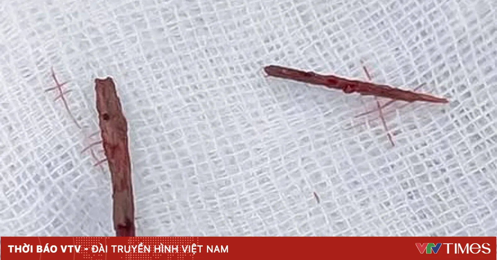 Xương cá đâm thủng manh tràng, gây áp xe thành bụng