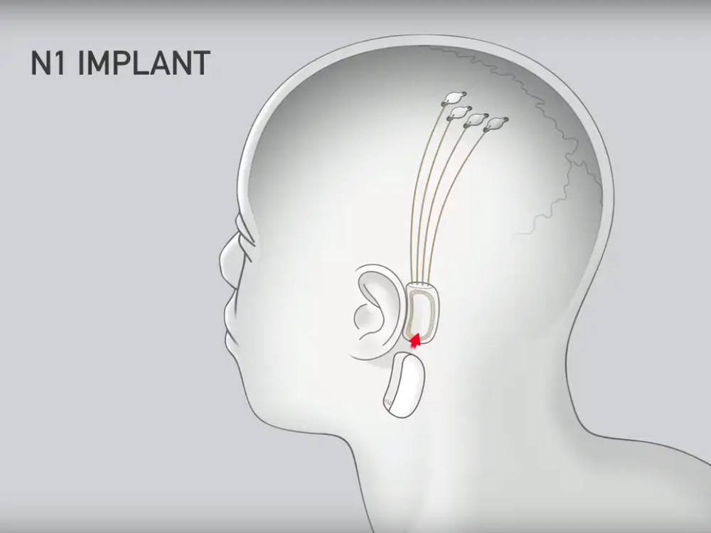 Triển vọng thử nghiệm cấy chip của công ty Neuralink - Ảnh 1.