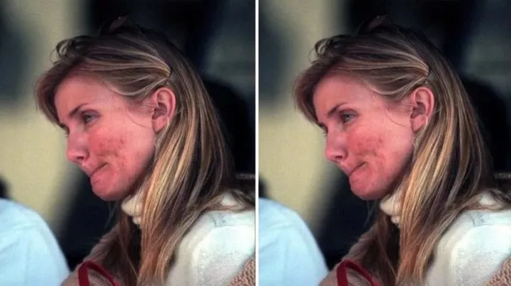 Khi loạt sao Hollywood đau đầu, &ldquo;khổ sở&rdquo; v&igrave; mụn trứng c&aacute; - Ảnh 1.