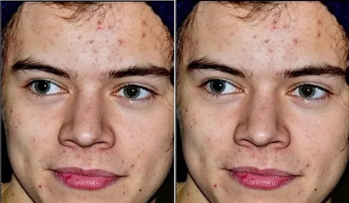 Khi loạt sao Hollywood đau đầu, &ldquo;khổ sở&rdquo; v&igrave; mụn trứng c&aacute; - Ảnh 2.