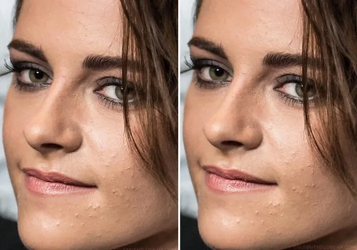 Khi loạt sao Hollywood đau đầu, &ldquo;khổ sở&rdquo; v&igrave; mụn trứng c&aacute; - Ảnh 3.