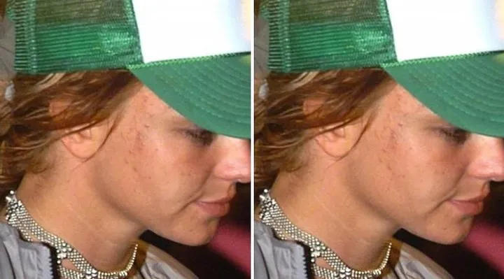 Khi loạt sao Hollywood đau đầu, &ldquo;khổ sở&rdquo; v&igrave; mụn trứng c&aacute; - Ảnh 6.