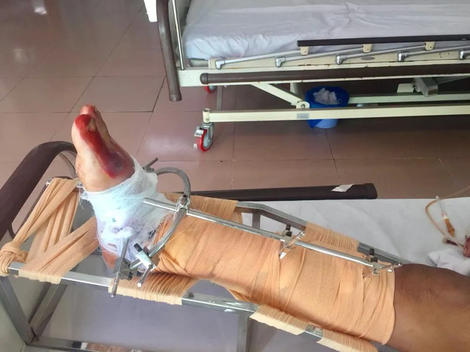 Nối thành công cổ chân gần đứt rời cho người đàn ông làm nghề bốc vác - Ảnh 1. Nối thành công cổ chân gần đứt rời cho người đàn ông làm nghề bốc vác - Ảnh 1.