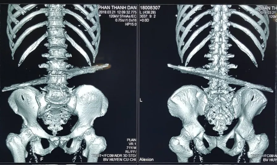 Thanh sắt dài 40cm đâm thủng bụng, cột sống và thắt lưng bệnh nhân - Ảnh 1. Thanh sắt dài 40cm đâm thủng bụng, cột sống và thắt lưng bệnh nhân - Ảnh 1.