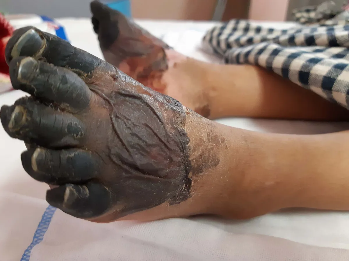 Sau một cơn sốt: Bé gái 3 tuổi bị hoại tử tay, chân - Ảnh 2. Sau một cơn sốt: Bé gái 3 tuổi bị hoại tử tay, chân - Ảnh 2.