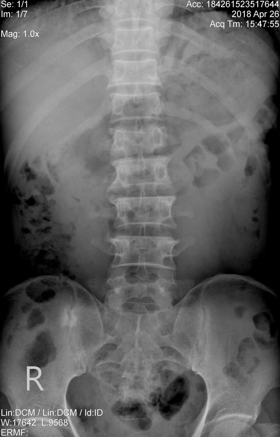 Phẫu thuật cố định cột sống cho bệnh nhân 51 tuổi sau tai nạn lao động - Ảnh 1. Phẫu thuật cố định cột sống cho bệnh nhân 51 tuổi sau tai nạn lao động - Ảnh 1.