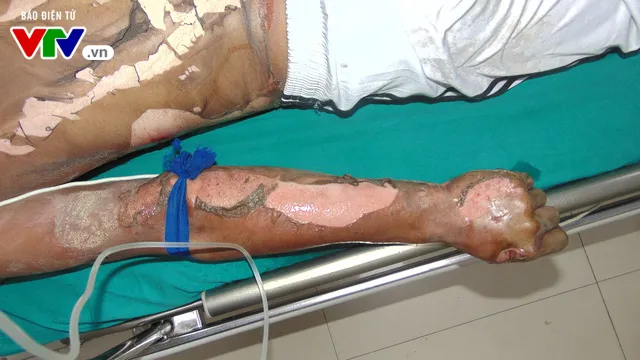Cấp cứu cho bệnh nhân bị bỏng xăng nguy kịch tính mạng - Ảnh 3. Cấp cứu cho bệnh nhân bị bỏng xăng nguy kịch tính mạng - Ảnh 3.