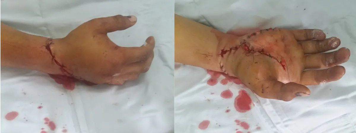 9 giờ nối thành công bàn tay đứt lìa cho một bệnh nhân nam 21 tuổi - Ảnh 2. 9 giờ nối thành công bàn tay đứt lìa cho một bệnh nhân nam 21 tuổi - Ảnh 2.