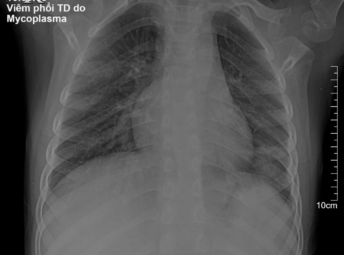 Cẩn trọng với viêm phổi nặng do Mycoplasma ở trẻ - Ảnh 2. Cẩn trọng với viêm phổi nặng do Mycoplasma ở trẻ - Ảnh 2.