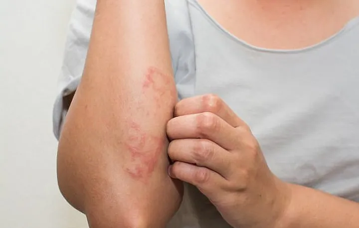 Các loại bệnh có thể lây nhiễm từ hồ bơi - Ảnh 4. Các loại bệnh có thể lây nhiễm từ hồ bơi - Ảnh 4.