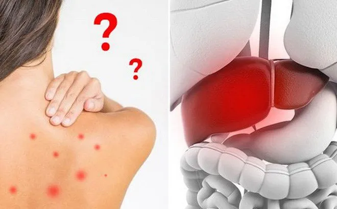 Mụn nhọt, mẩn ngứa, nóng trong, biểu hiện của nhiễm độc gan - Ảnh 1. Mụn nhọt, mẩn ngứa, nóng trong, biểu hiện của nhiễm độc gan - Ảnh 1.