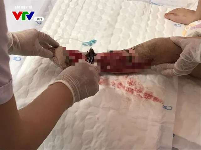 Thương tâm: Cháu bé 20 tháng tuổi bị bố lùi xe chèn nát chân - Ảnh 2.
