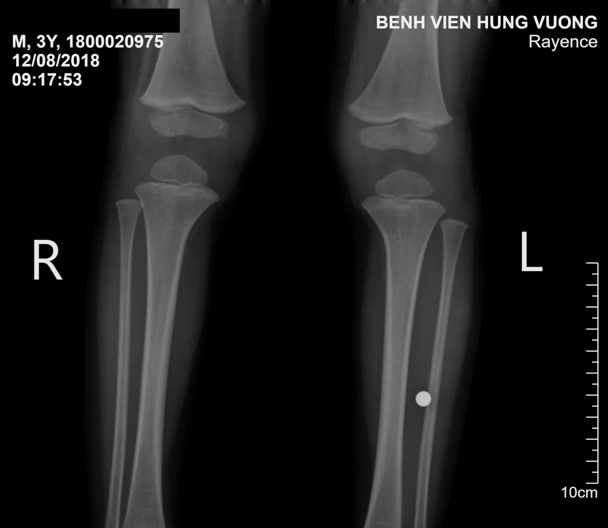 Phát hiện viên bi trong cẳng chân bé trai 3 tuổi - Ảnh 1.