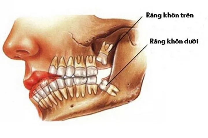 Đau răng khôn: Những điều quan trọng bạn cần biết - Ảnh 1.