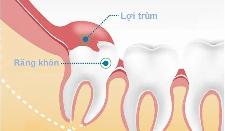 Đau răng khôn: Những điều quan trọng bạn cần biết - Ảnh 2.