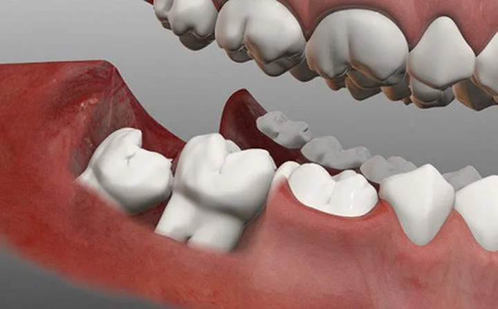 Đau răng khôn: Những điều quan trọng bạn cần biết - Ảnh 10.