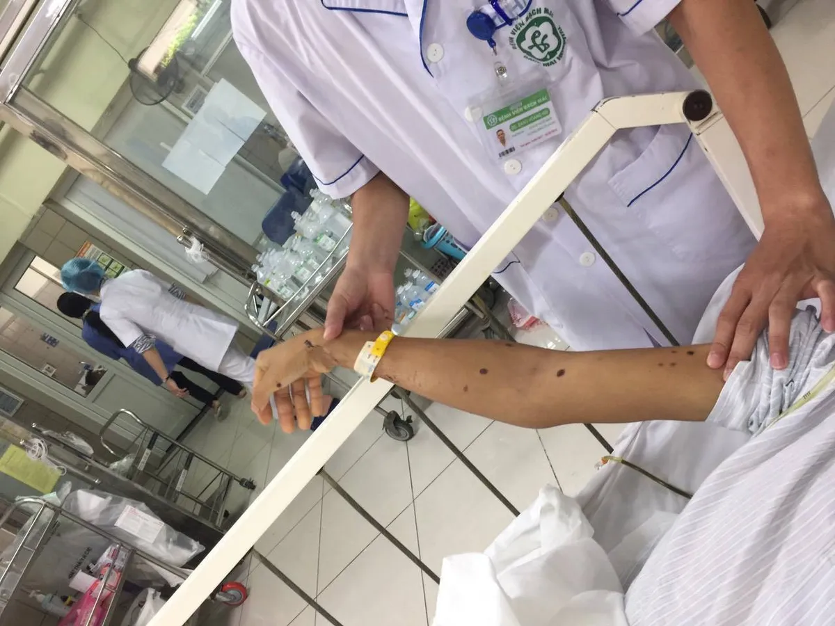 Hậu họa không ngờ sau khi bị ong vò vẽ tấn công - Ảnh 1.