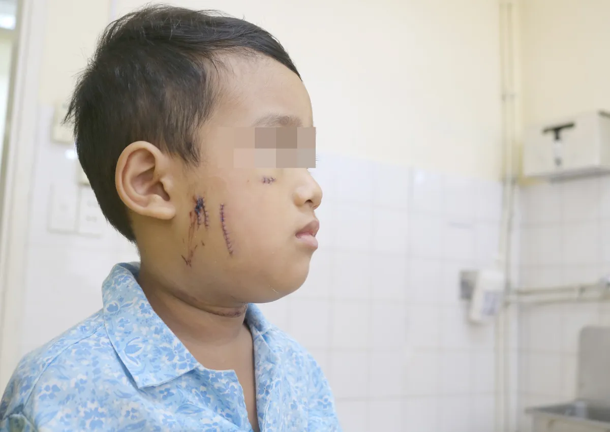 Bé 4 tuổi bị chó nhà tấn công nhập viện - Ảnh 1. Bé 4 tuổi bị chó nhà tấn công nhập viện - Ảnh 1.