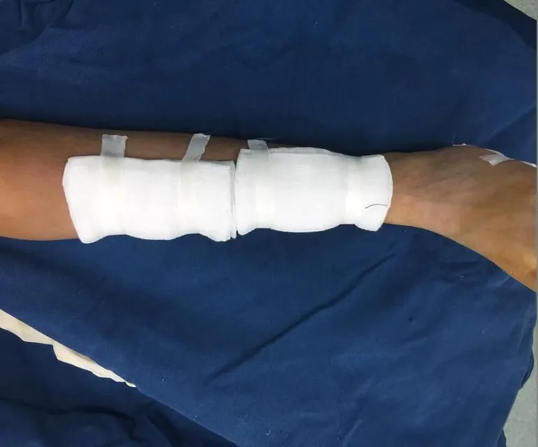 Bị loạn sản xơ xương, bé 8 tuổi cẳng chân biến dạng - Ảnh 1.