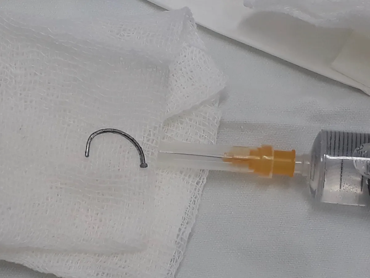 Rùng mình: Gắp cây đinh dài 2,5cm trong... mắt người đàn ông - Ảnh 2.
