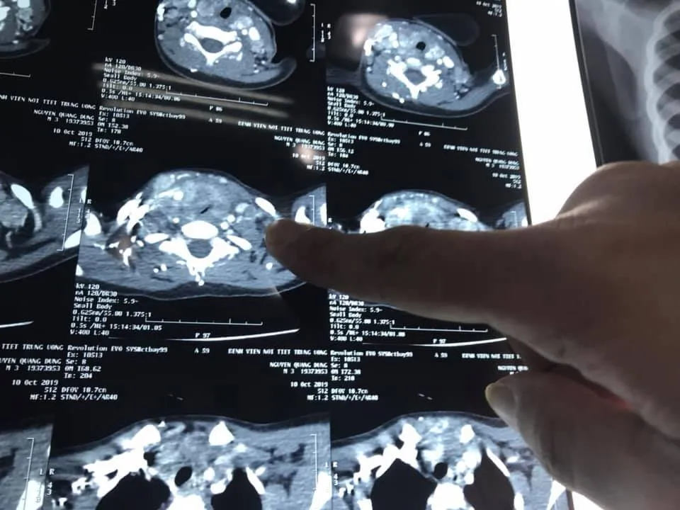 Ngỡ ng&agrave;ng: B&eacute; trai mới 3 tuổi đ&atilde; mắc ung thư tuyến gi&aacute;p thể tủy di căn - Ảnh 2.