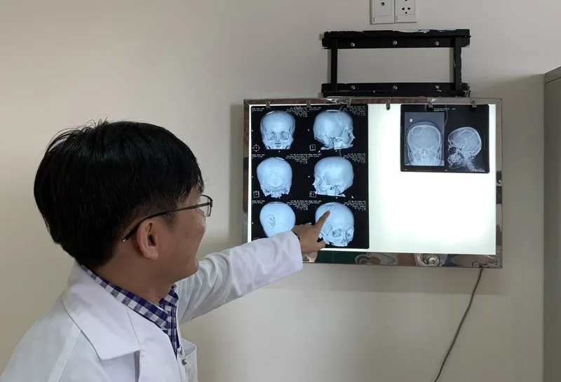 Tạo hình hộp sọ vỡ nát cho nam công nhân bị tai nạn lao động - Ảnh 1. Tạo hình hộp sọ vỡ nát cho nam công nhân bị tai nạn lao động - Ảnh 1.