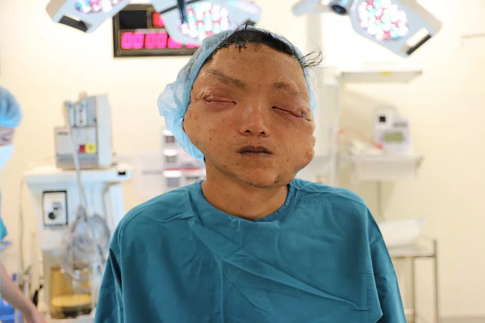 Giải thoát cho nam thanh niên khỏi khối u làm biến dạng khuôn mặt suốt 17 năm - Ảnh 2. Giải thoát cho nam thanh niên khỏi khối u làm biến dạng khuôn mặt suốt 17 năm - Ảnh 2.