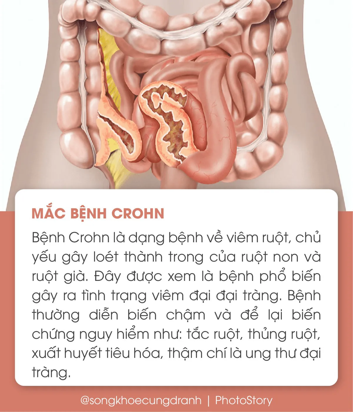5 nguyên nhân phổ biến gây viêm đại tràng - Ảnh 4. 5 nguyên nhân phổ biến gây viêm đại tràng - Ảnh 4.