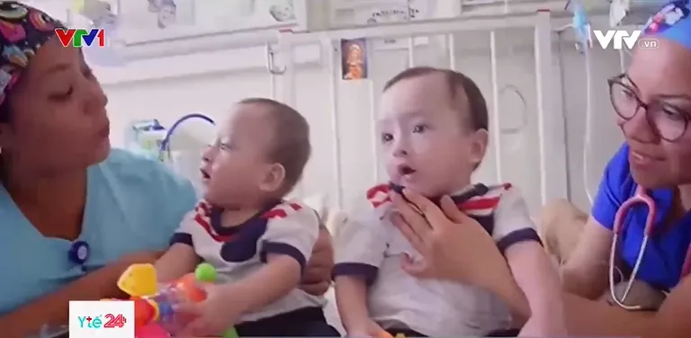 Phẫu thuật thành công cho cặp song sinh dính liền hy hữu - Ảnh 2. Phẫu thuật thành công cho cặp song sinh dính liền hy hữu - Ảnh 2.