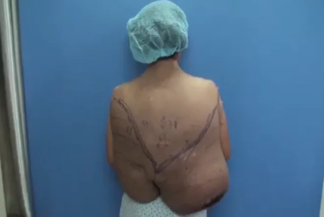 Người phụ nữ dân tộc Mường 15 năm mang trên mình khối u xơ thần kinh nặng 12kg - Ảnh 1.