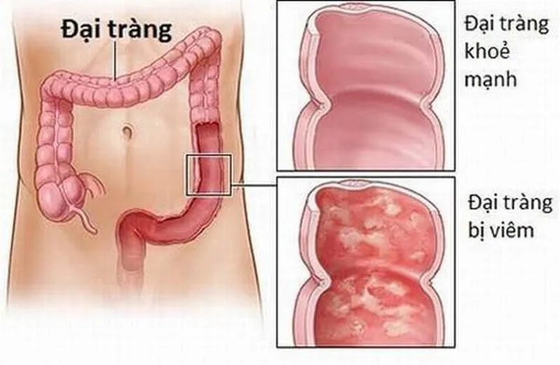 Lý giải những hiểu lầm bấy lâu nay về bệnh đại tràng co thắt - Ảnh 1.