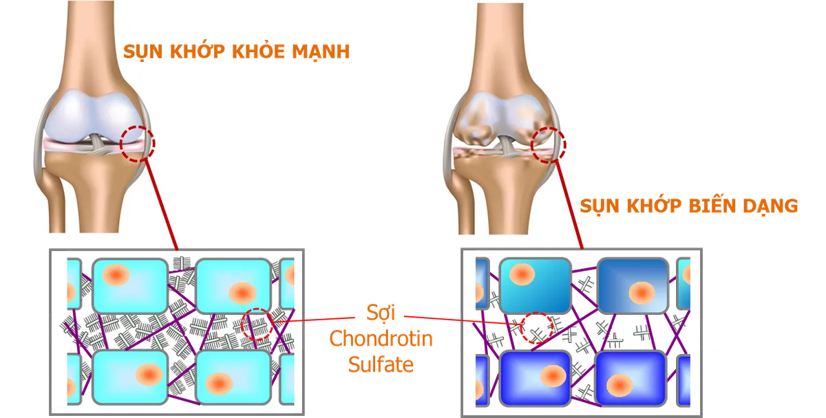 Chondro Support - Sản phẩm hỗ trợ sụn khớp của người Nhật - Ảnh 2. Chondro Support - Sản phẩm hỗ trợ sụn khớp của người Nhật - Ảnh 2.