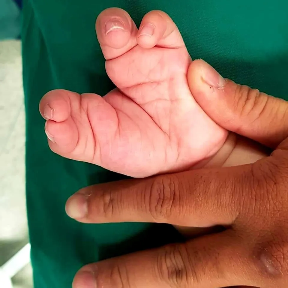 Giải thoát bé trai 2 tuổi khỏi đôi tay càng tôm hùm - Ảnh 1. Giải thoát bé trai 2 tuổi khỏi đôi tay càng tôm hùm - Ảnh 1.
