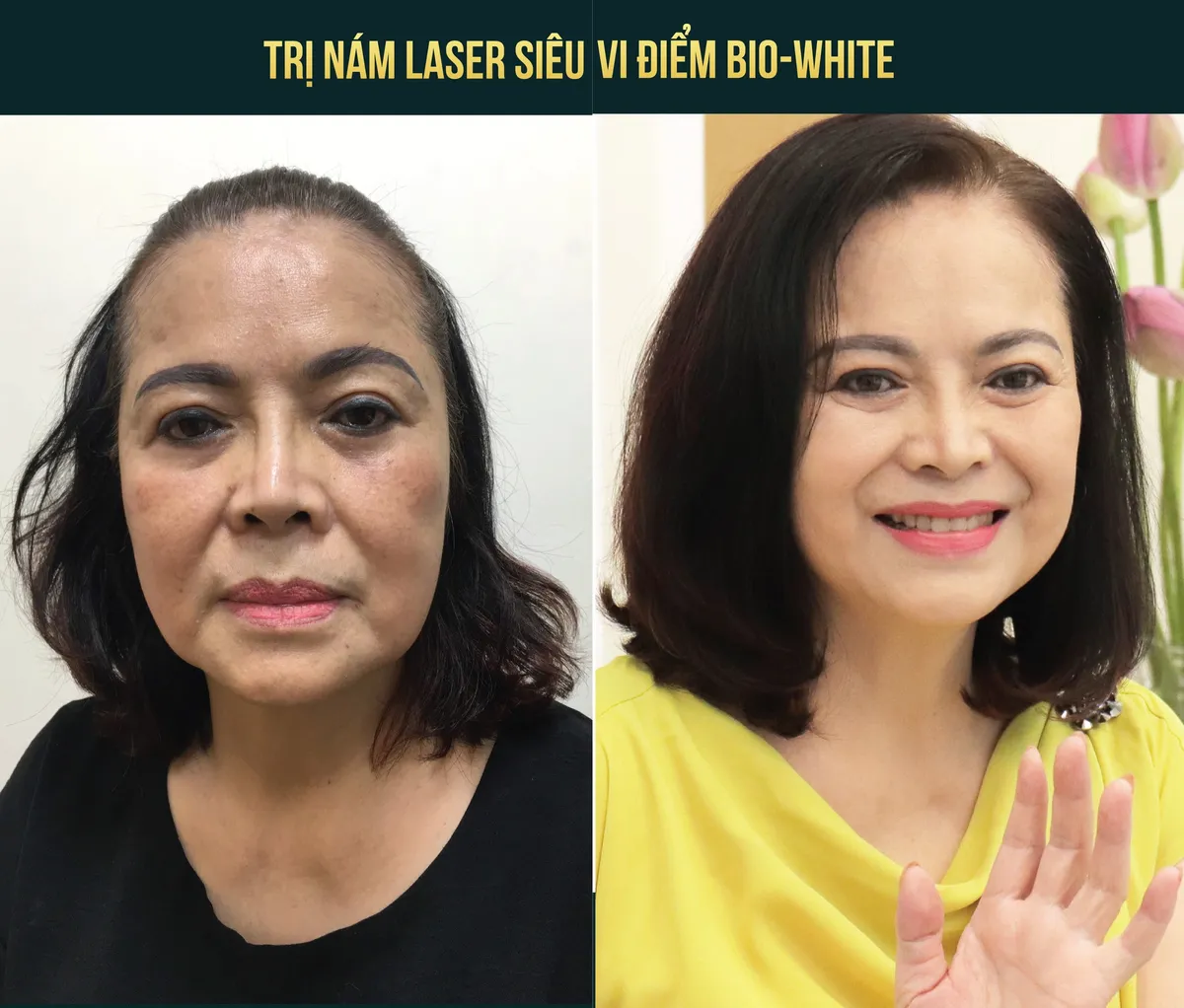 Bước tiến trong điều trị xóa tan nỗi lo về nám - Ảnh 1.