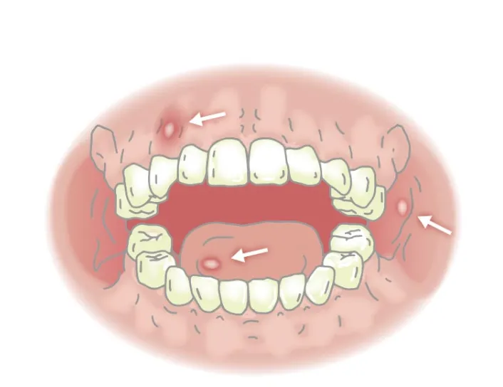 Bệnh ngoài da do virus thủy đậu, sởi, viêm loét miệng... là gì? - Ảnh 2.