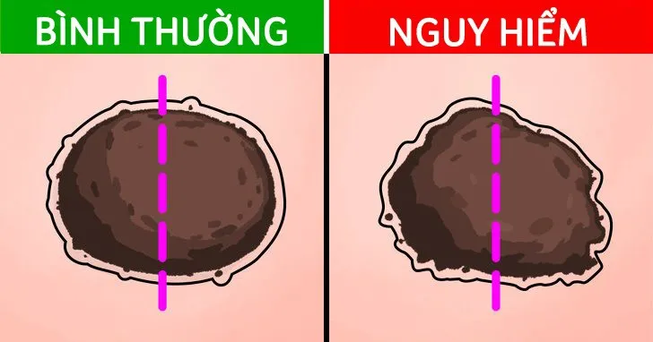 5 tín hiệu từ nốt ruồi cảnh báo ung thư đang tiềm ẩn - Ảnh 1. 5 tín hiệu từ nốt ruồi cảnh báo ung thư đang tiềm ẩn - Ảnh 1.