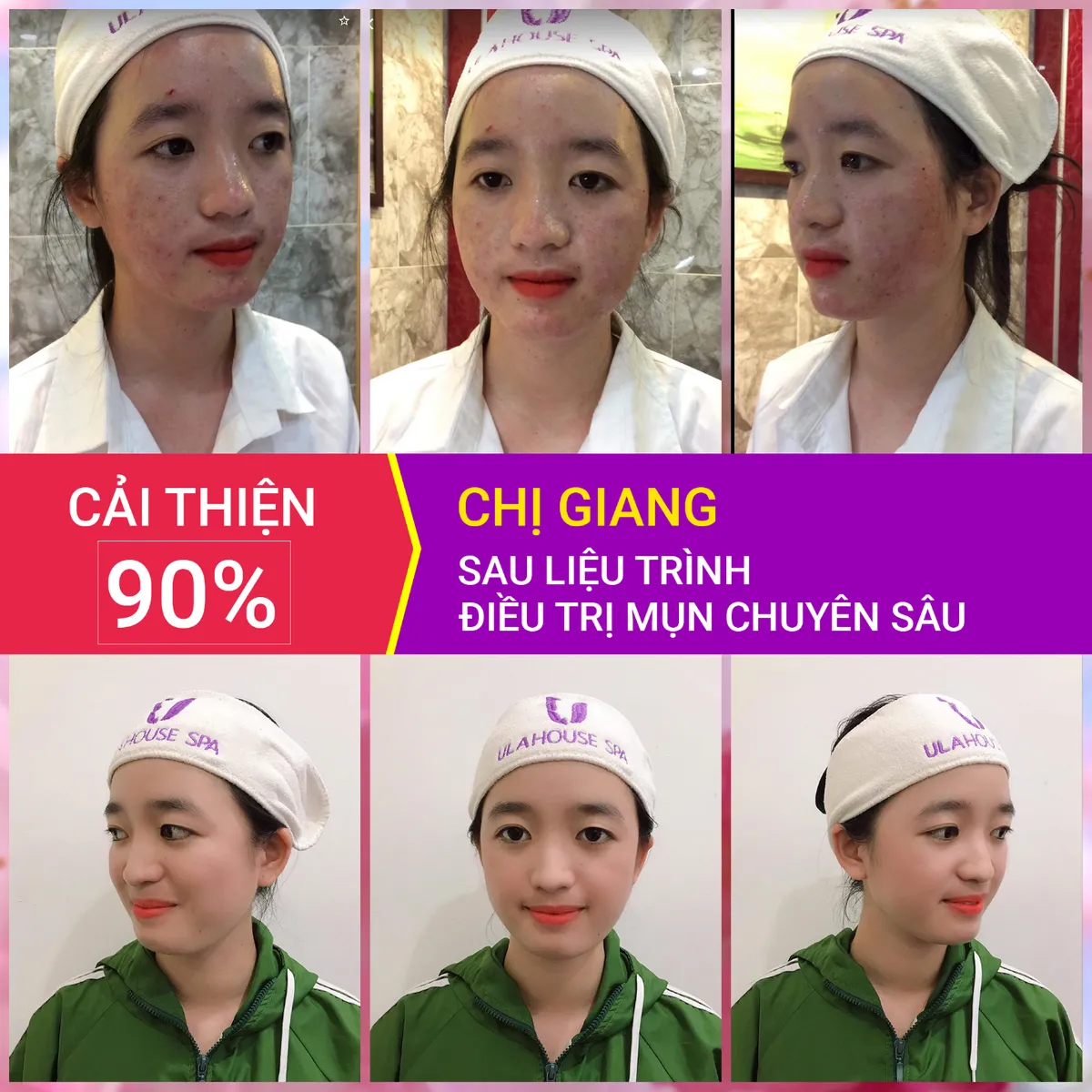 Muốn đẹp lên thì trước hết hãy tiêu diệt hết kẻ thù không đội trời chung: Mụn! - Ảnh 4.